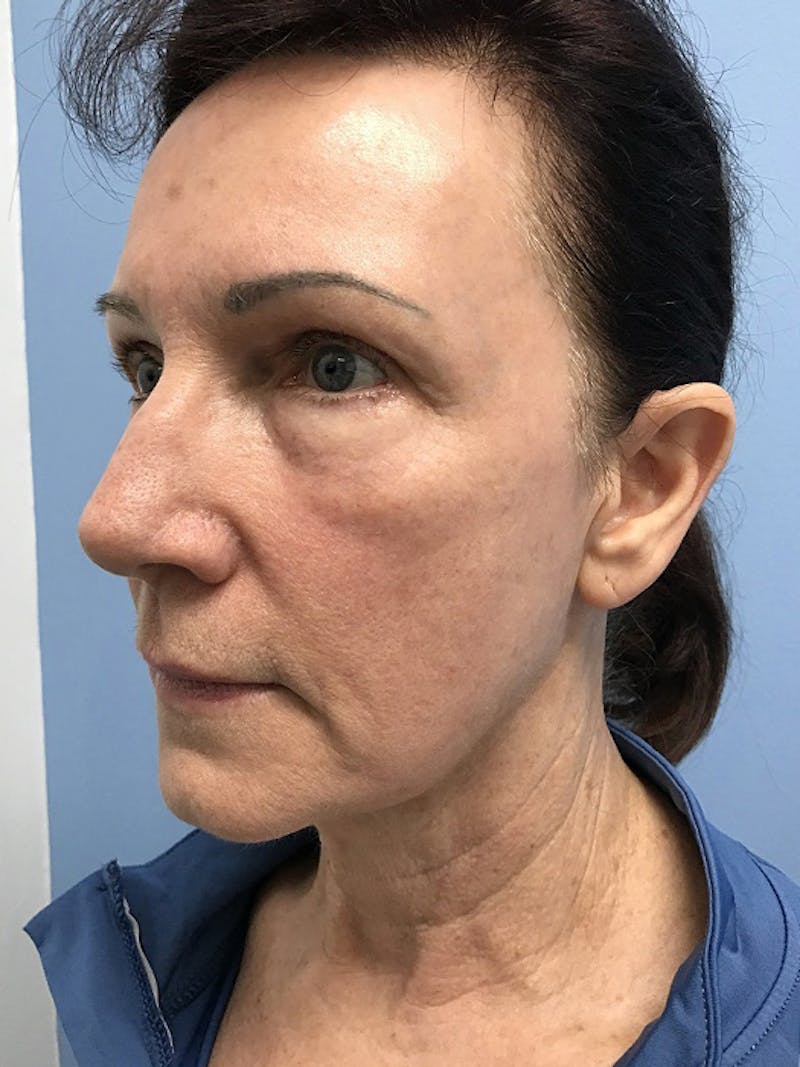 CO2 Laser Before & After Gallery - Patient 120905834 - Image 4