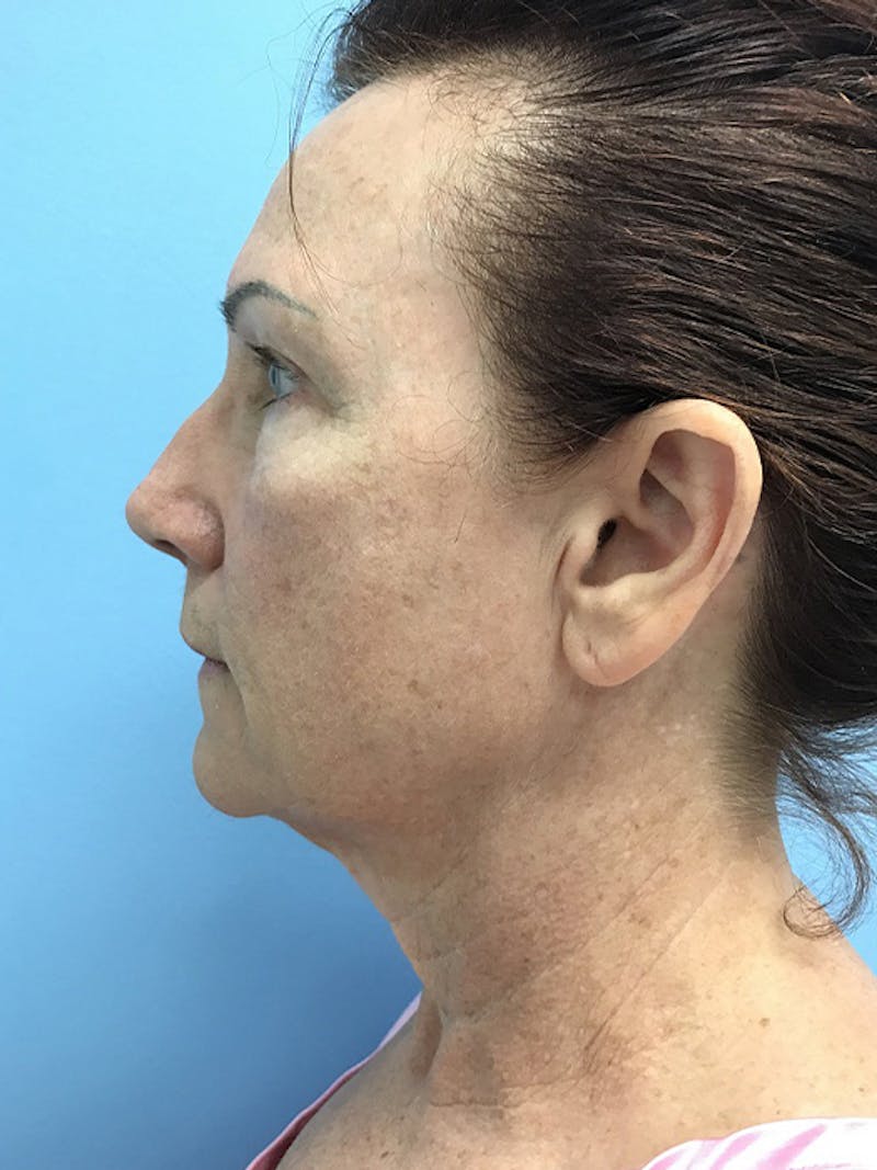 CO2 Laser Before & After Gallery - Patient 120905834 - Image 5