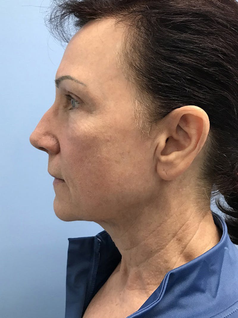 CO2 Laser Before & After Gallery - Patient 120905834 - Image 6