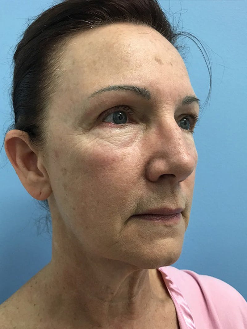 CO2 Laser Before & After Gallery - Patient 120905834 - Image 7