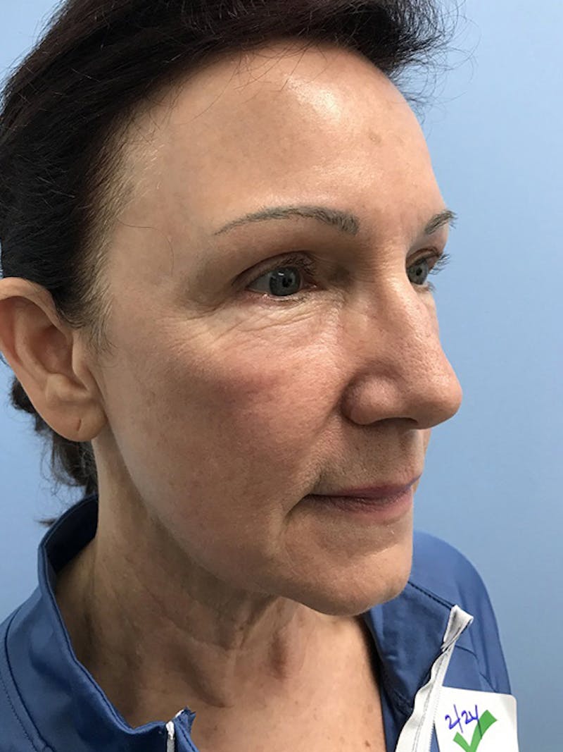 CO2 Laser Before & After Gallery - Patient 120905834 - Image 8