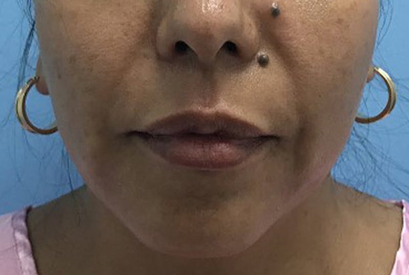 Injectables Before & After Gallery - Patient 120905839 - Image 1
