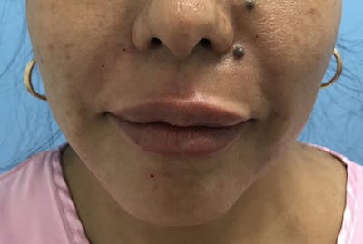 Injectables Before & After Gallery - Patient 120905839 - Image 2