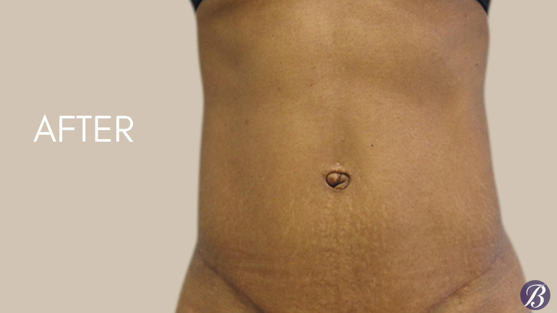 tummy tuck after photo