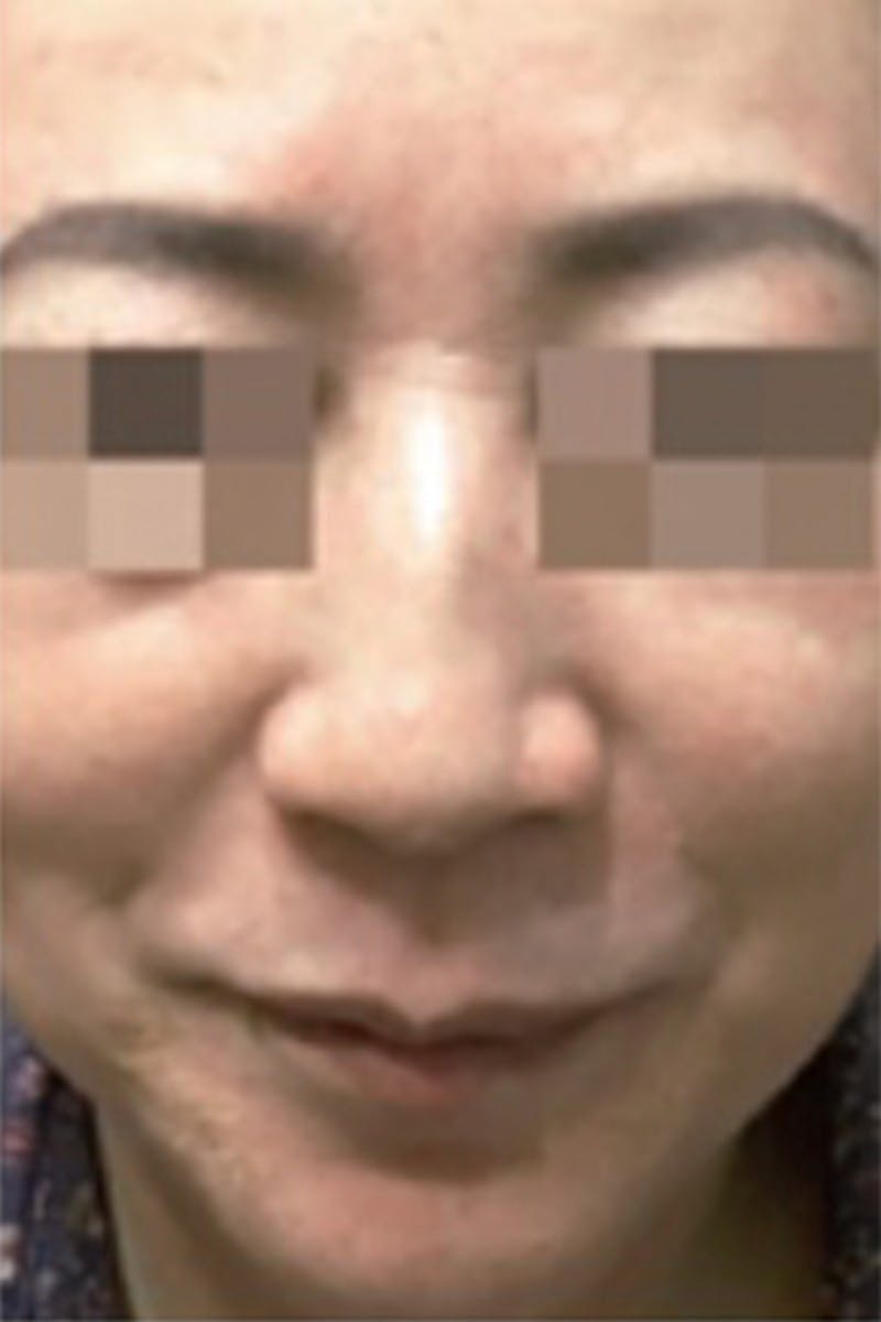 Cosmelan Peel Before & After Gallery - Patient 146925463 - Image 4