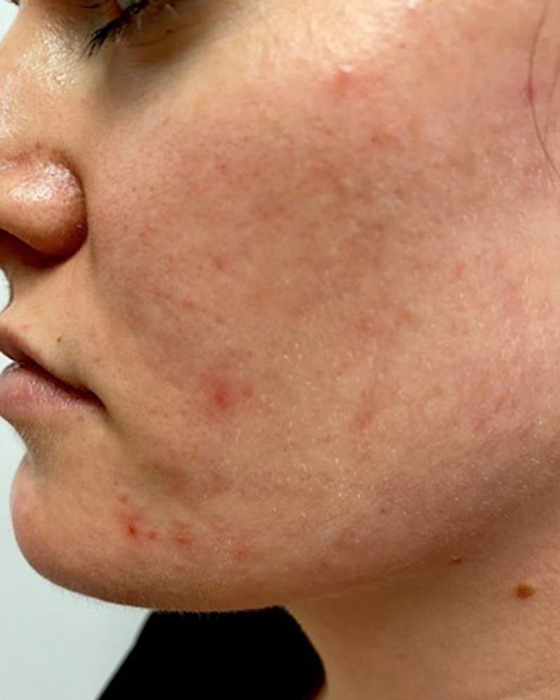 BBL Forever Young Before & After Gallery - Patient 146925467 - Image 1