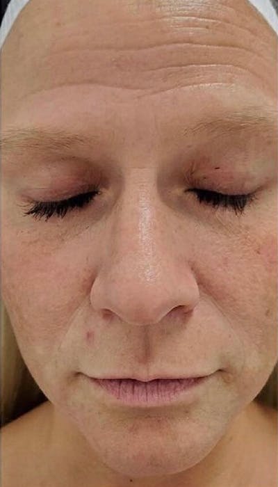 Microneedling Before & After Gallery - Patient 146925473 - Image 2