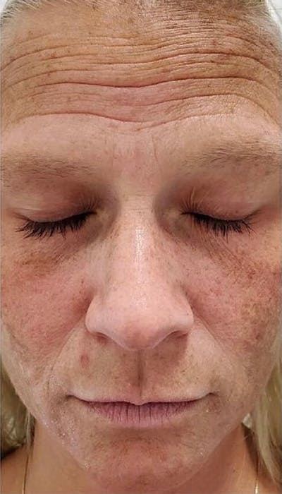 Microneedling Before & After Gallery - Patient 146925473 - Image 1
