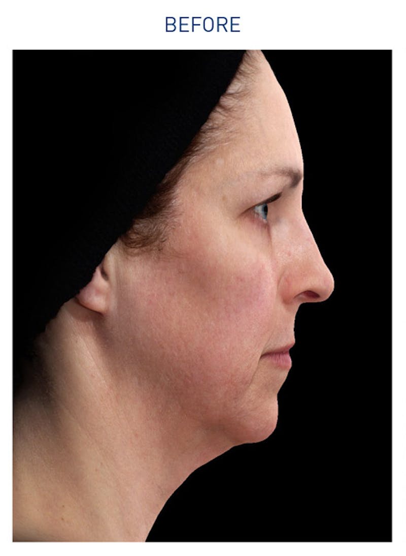 Renuvion Before & After Gallery - Patient 148590043 - Image 1