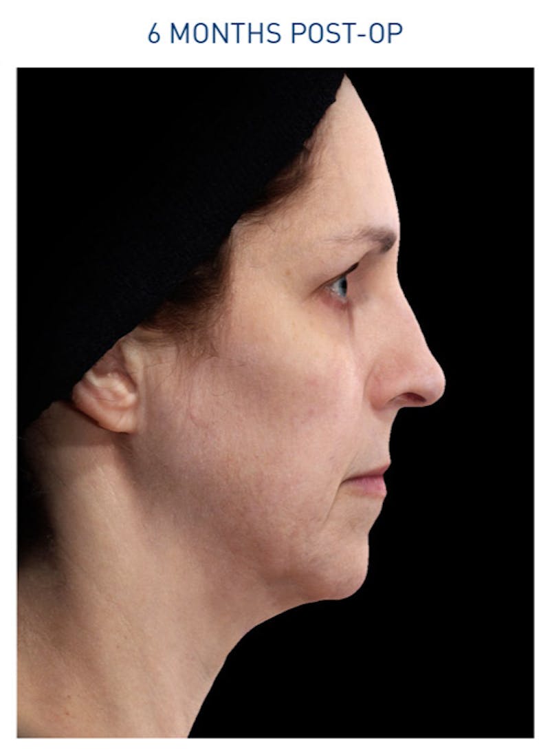 Renuvion Before & After Gallery - Patient 148590043 - Image 2