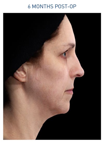 Renuvion Before & After Gallery - Patient 148590043 - Image 2