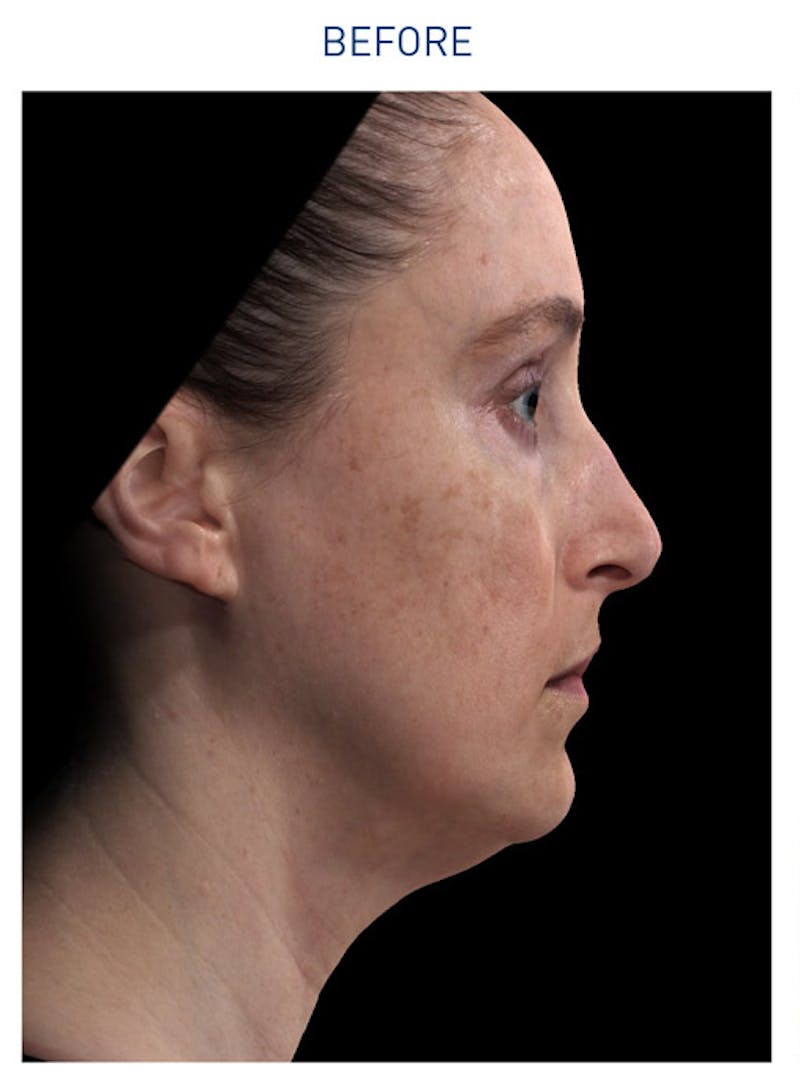 Renuvion Before & After Gallery - Patient 148590044 - Image 1