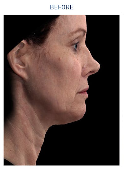 Renuvion Before & After Gallery - Patient 148590045 - Image 1