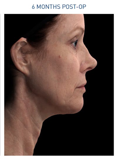 Renuvion Before & After Gallery - Patient 148590045 - Image 2