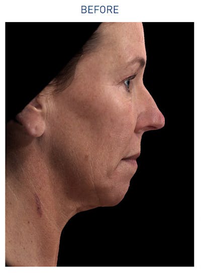 Renuvion Before & After Gallery - Patient 148590046 - Image 1