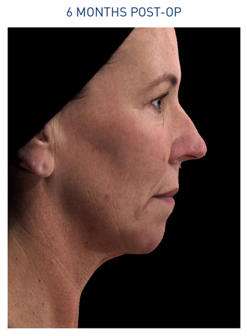 Renuvion Before & After Gallery - Patient 148590046 - Image 2