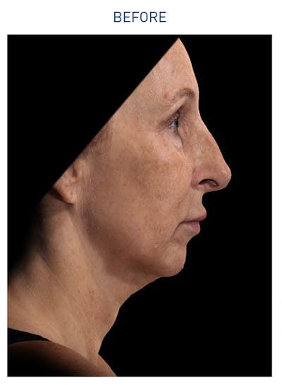 Renuvion Before & After Gallery - Patient 148590047 - Image 1