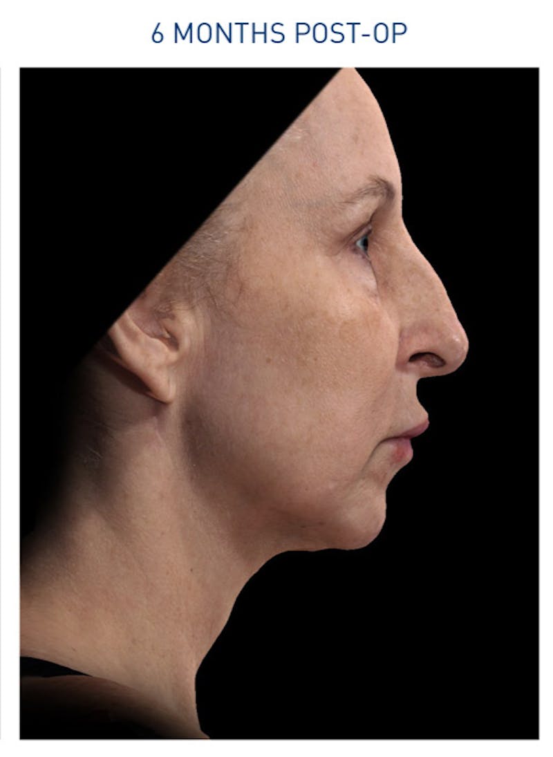 Renuvion Before & After Gallery - Patient 148590047 - Image 2
