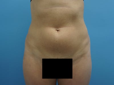 Liposuction Before & After Gallery - Patient 120905256 - Image 1