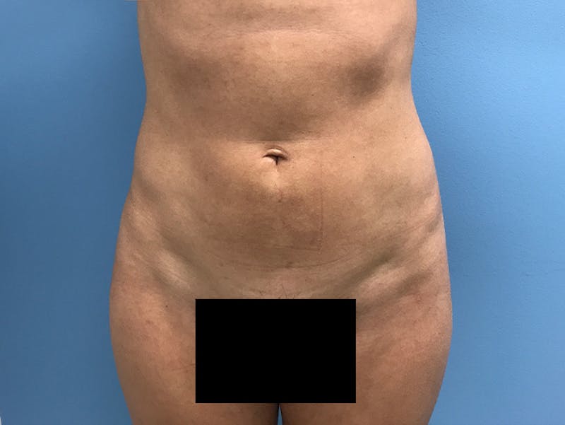 Liposuction Before & After Gallery - Patient 120905256 - Image 2