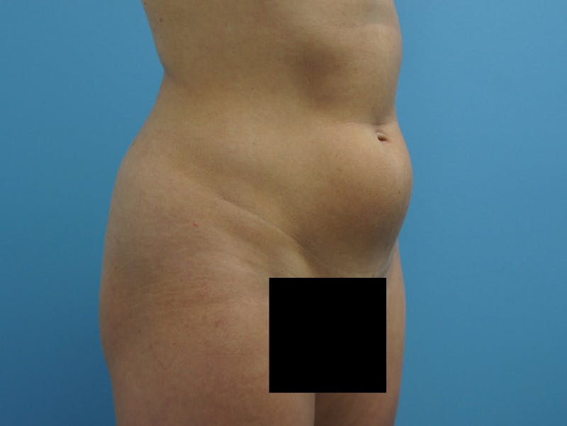 Liposuction Before & After Gallery - Patient 120905256 - Image 3