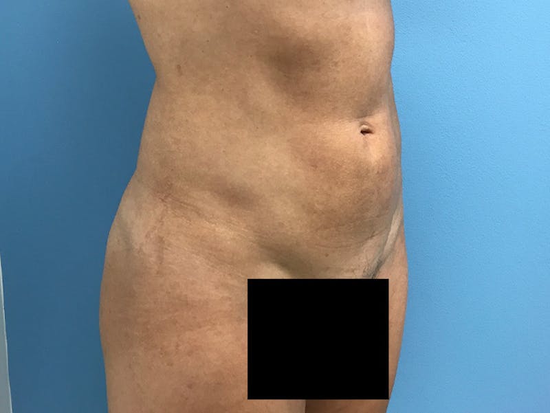 Liposuction Before & After Gallery - Patient 120905256 - Image 4