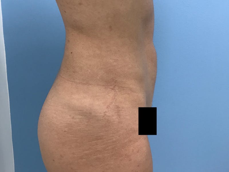 Liposuction Before & After Gallery - Patient 120905256 - Image 6