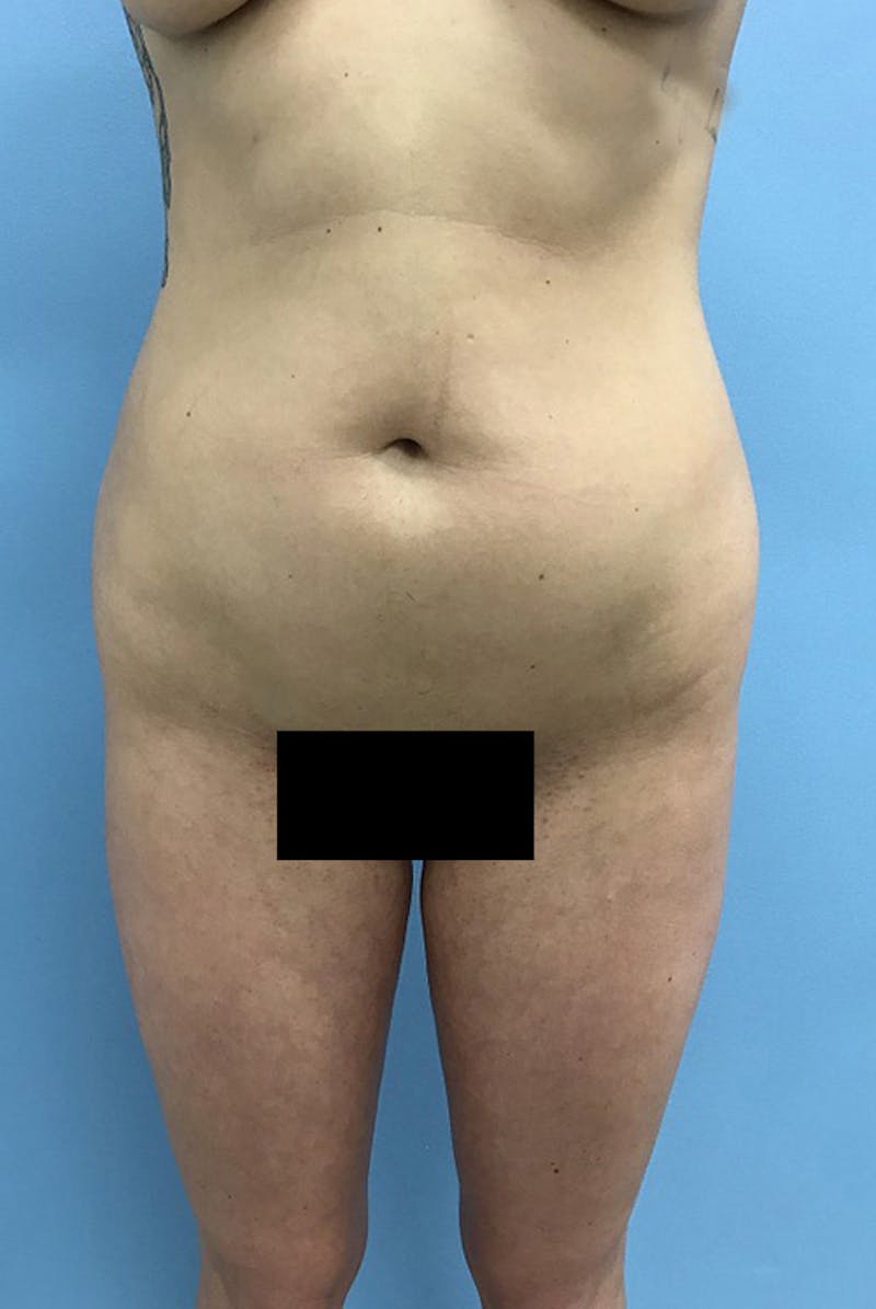 Liposuction Before & After Gallery - Patient 120905273 - Image 1