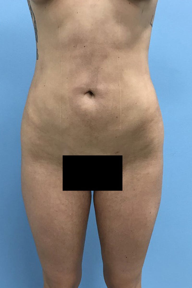 Liposuction Before & After Gallery - Patient 120905273 - Image 2