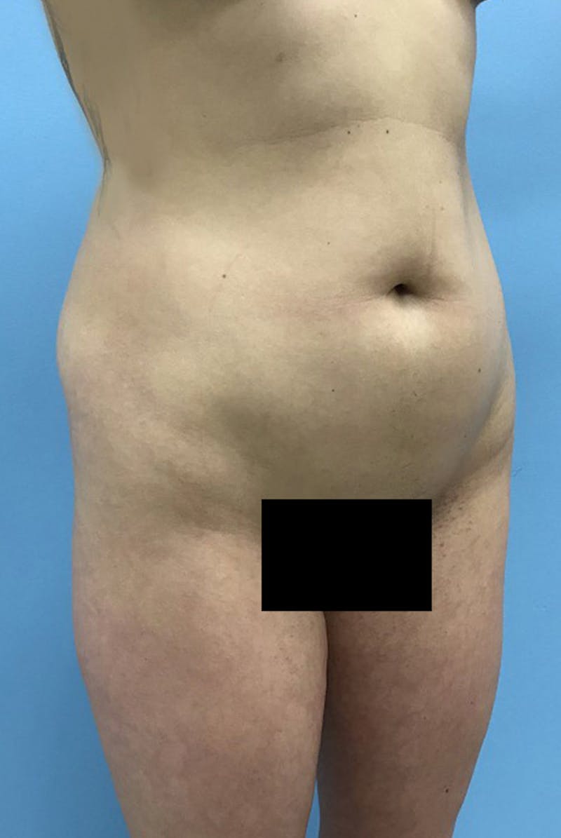Liposuction Before & After Gallery - Patient 120905273 - Image 3