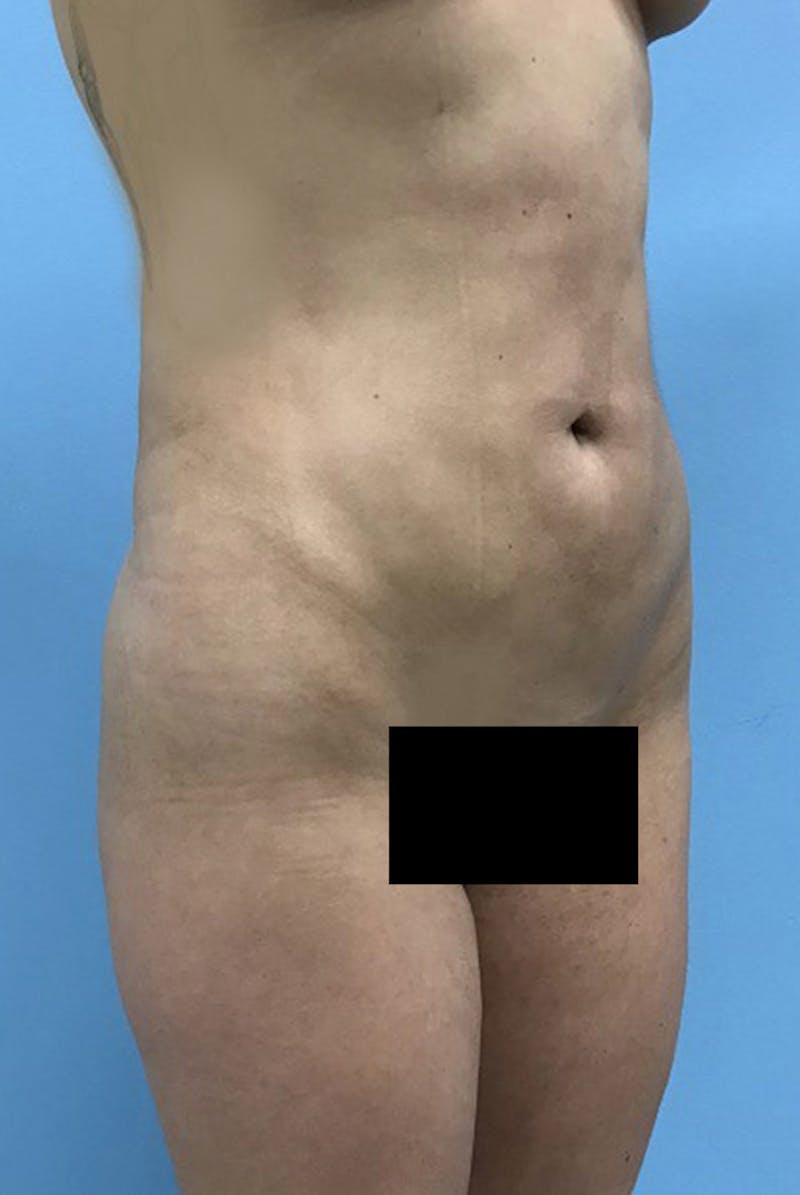 Liposuction Before & After Gallery - Patient 120905273 - Image 4