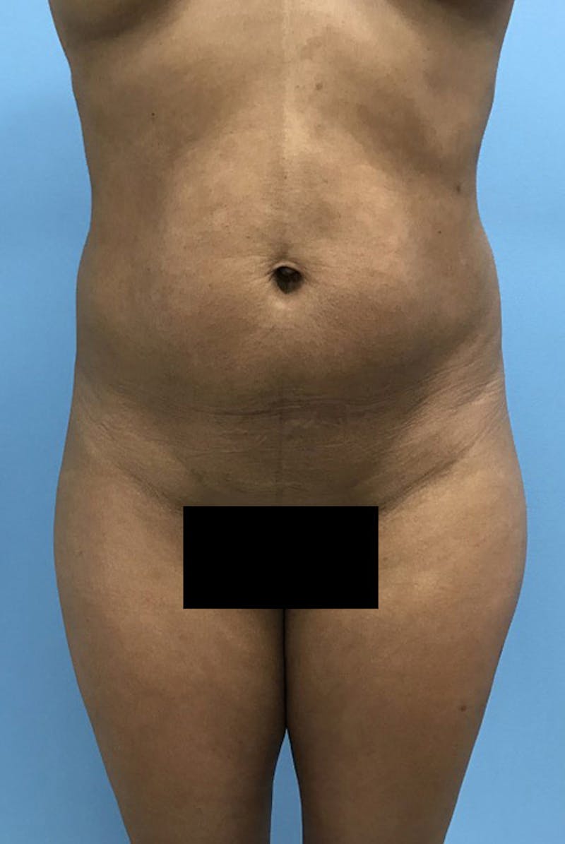Liposuction Before & After Gallery - Patient 120905276 - Image 1
