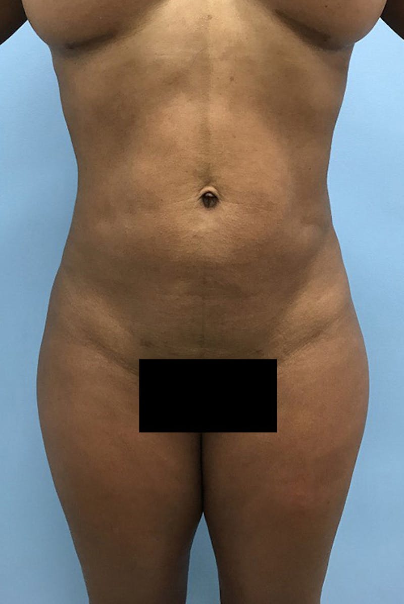 Liposuction Before & After Gallery - Patient 120905276 - Image 2