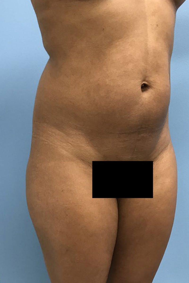 Liposuction Before & After Gallery - Patient 120905276 - Image 3