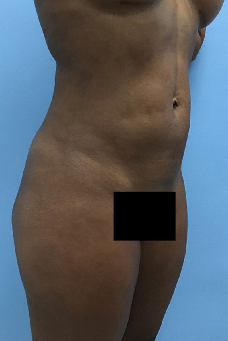 Liposuction Before & After Gallery - Patient 120905276 - Image 4