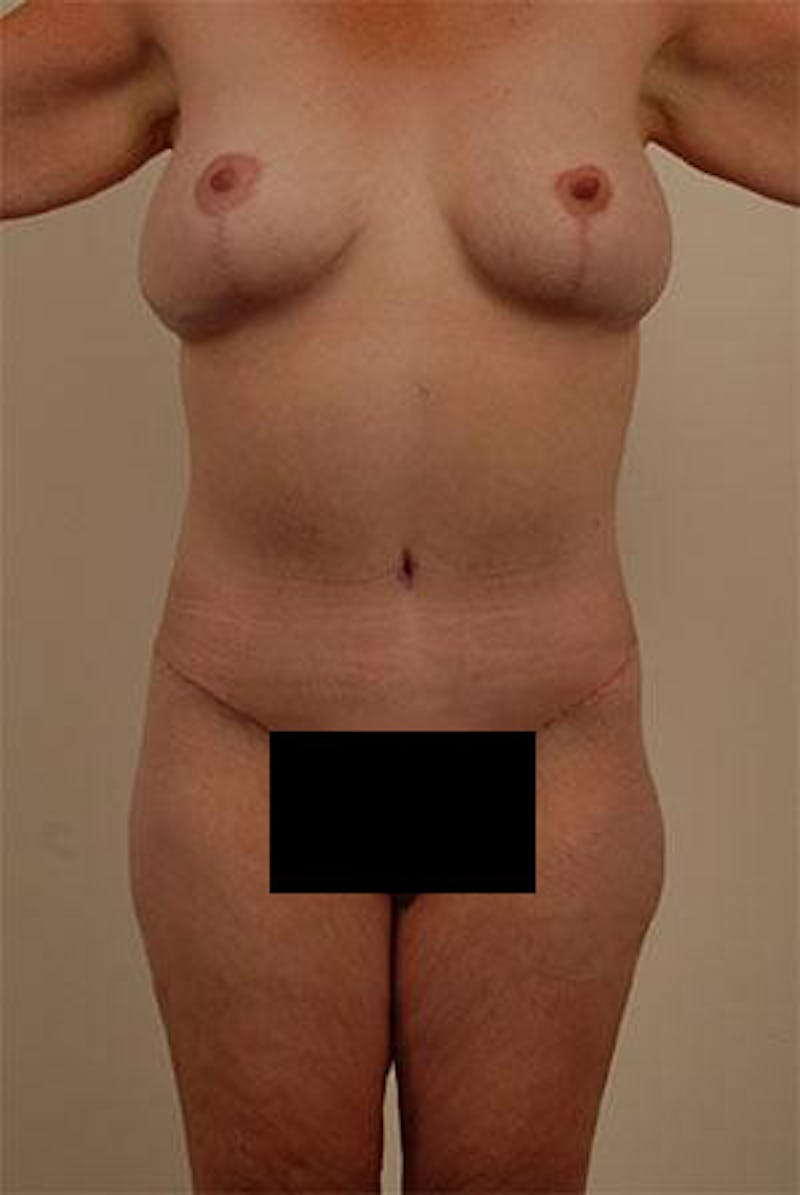 After Major Weight Loss Before & After Gallery - Patient 120905288 - Image 2