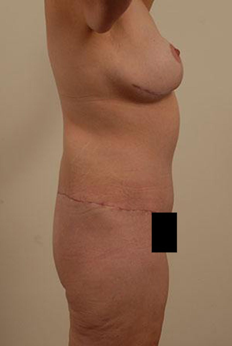 After Major Weight Loss Before & After Gallery - Patient 120905288 - Image 4
