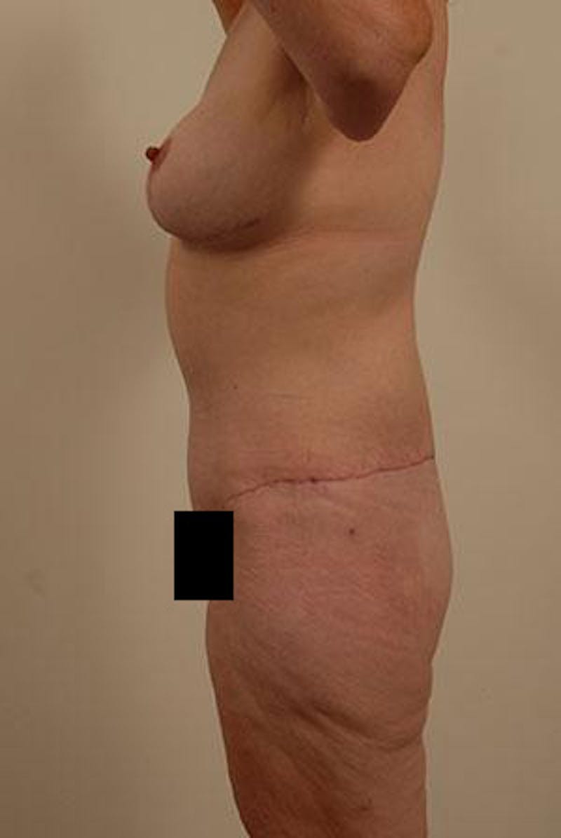 After Major Weight Loss Before & After Gallery - Patient 120905288 - Image 6