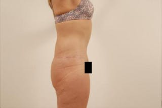 After Major Weight Loss Before & After Gallery - Patient 120905301 - Image 4