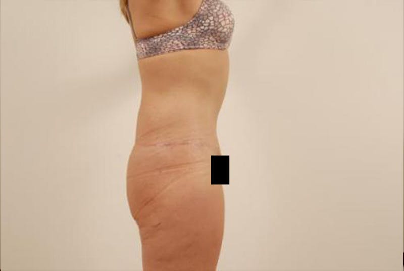 After Major Weight Loss Before & After Gallery - Patient 120905301 - Image 4