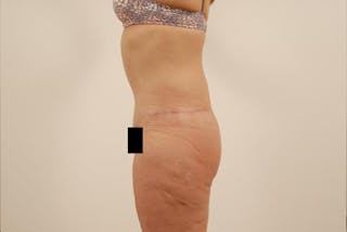 After Major Weight Loss Before & After Gallery - Patient 120905301 - Image 6