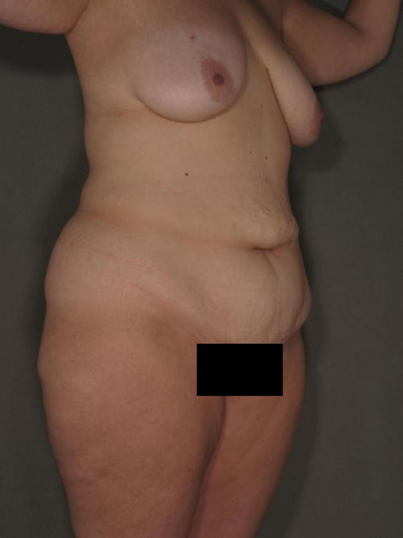 After Major Weight Loss Before & After Gallery - Patient 120905303 - Image 1