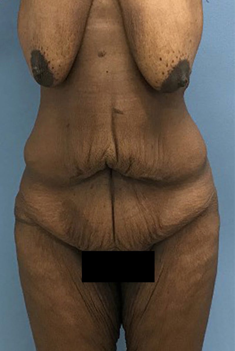 After Major Weight Loss Before & After Gallery - Patient 120905310 - Image 1