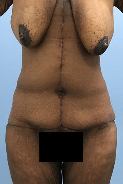 After Major Weight Loss Before & After Gallery - Patient 120905310 - Image 2
