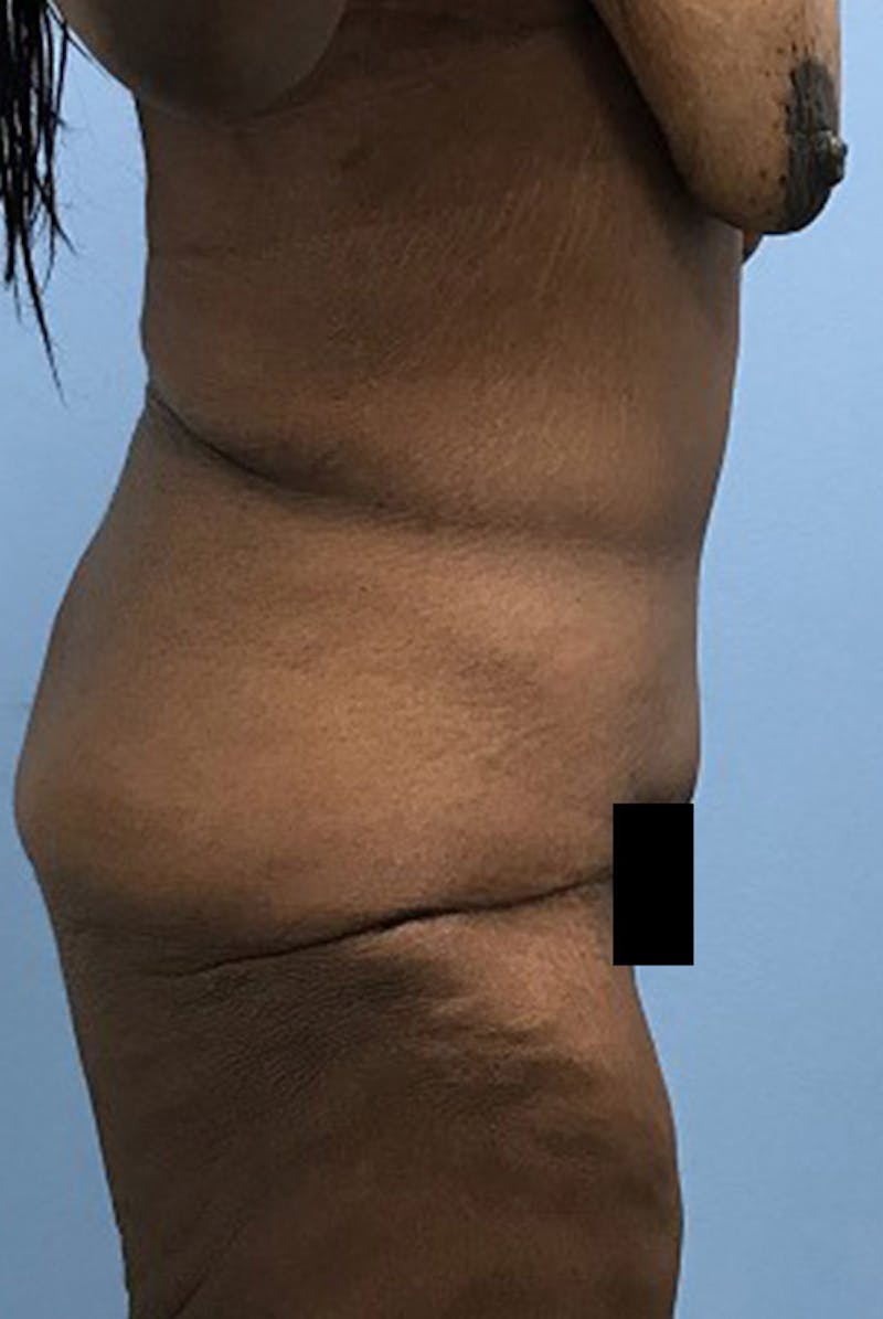 After Major Weight Loss Before & After Gallery - Patient 120905310 - Image 4