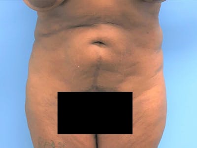 Tummy Tuck Before & After Gallery - Patient 120905387 - Image 1