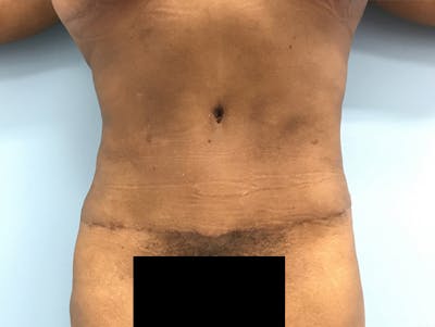 Tummy Tuck Before & After Gallery - Patient 120905387 - Image 2