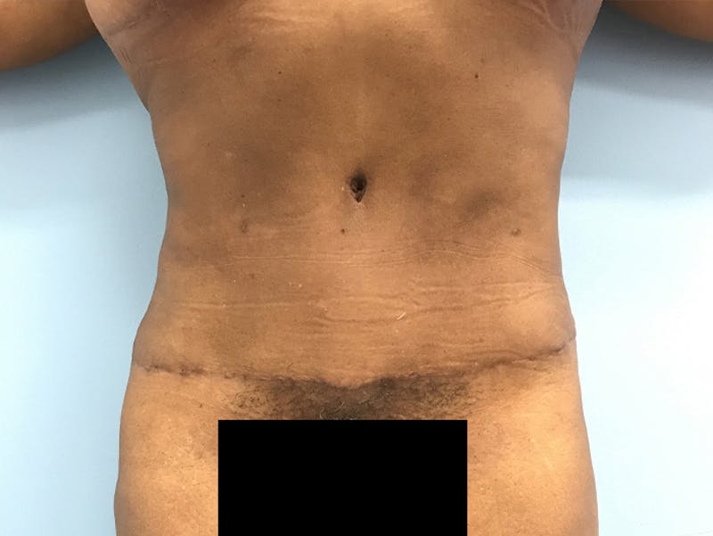 Tummy Tuck Before & After Gallery - Patient 120905387 - Image 2