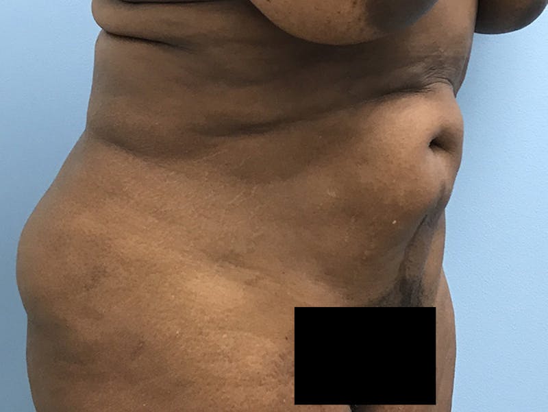 Tummy Tuck Before & After Gallery - Patient 120905387 - Image 3