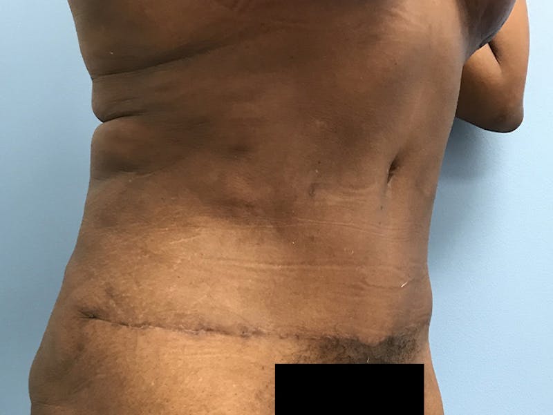 Tummy Tuck Before & After Gallery - Patient 120905387 - Image 4